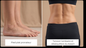 Pied plat pronateur et tension lombaire : illustration du lien postural entre déséquilibre du pied et douleur chronique du bas du dos